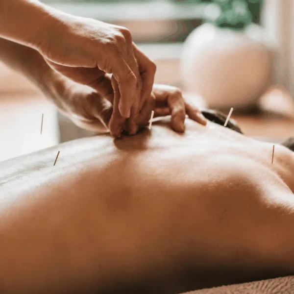 Acupuncture