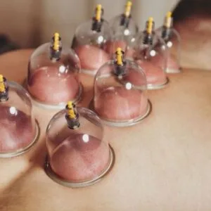 Cupping Therapy