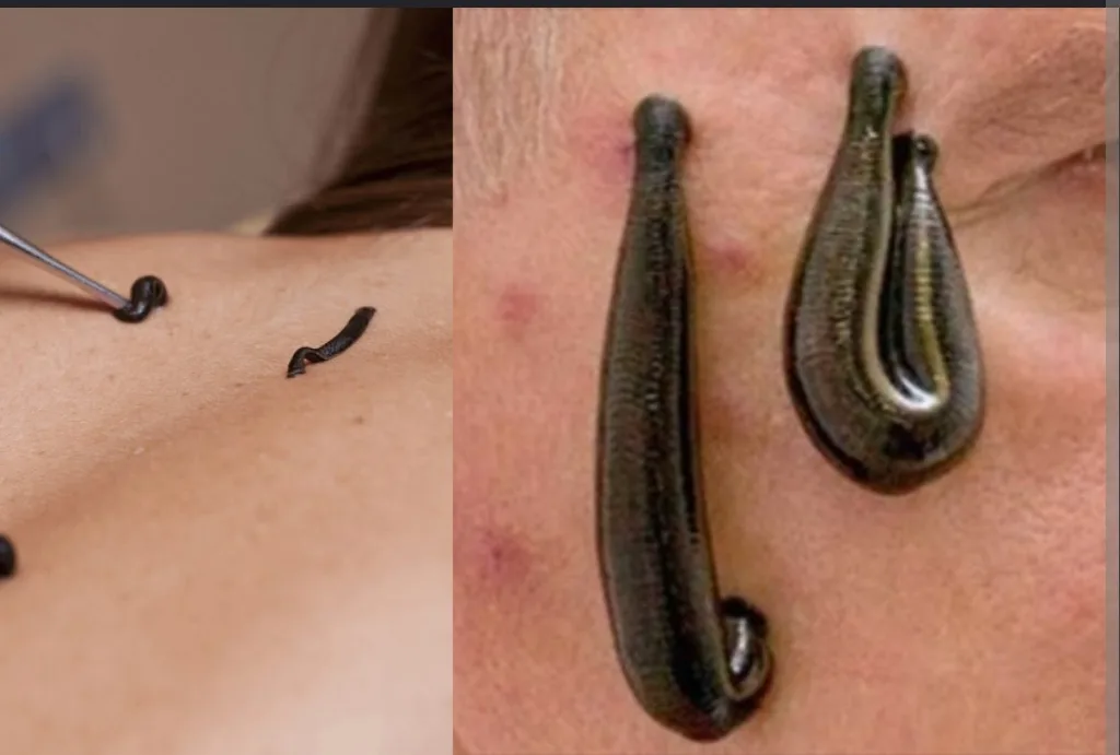GFC with Leech Therapy