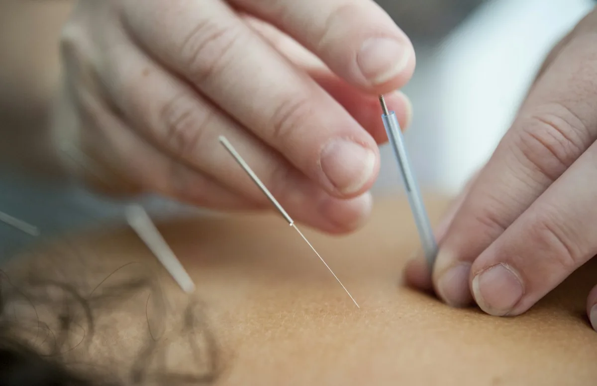 Acupuncture & Acupressure